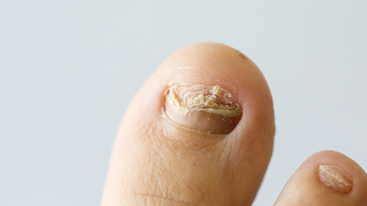 氧氟沙星能治疗灰指甲吗？氧氟沙星对于灰指甲的作用