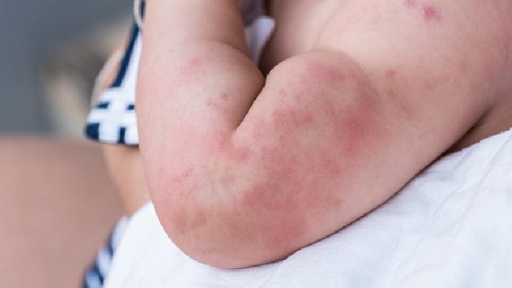 玫瑰糠疹病因是什么 玫瑰糠疹的发病前兆有什么