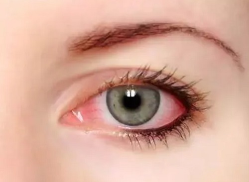 红眼病是怎么传染的 预防红眼病的七个方法是什么