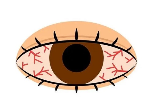 红眼病是怎么传染的 红眼病的危害有哪些